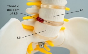 Cách giảm đau lưng do thoát vị đĩa đệm L4 L5 hiệu quả tại nhà 