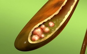 Sỏi bùn đầy túi mật dùng TPBVSK Kim Đởm Khang còn hiệu quả không?