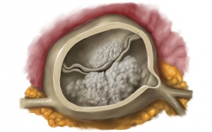 Người bệnh hở van tim làm sao ngừa vôi hóa van tim?