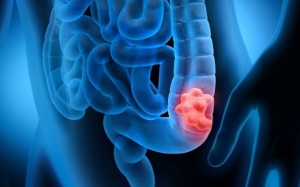 Ung thư đại trực tràng ngày càng trẻ hóa, nhận diện dấu hiệu sớm