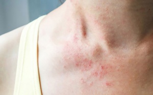 Tiếp xúc với không khí ô nhiễm có thể tăng nguy cơ mắc bệnh chàm