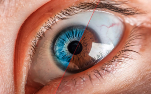 Phẫu thuật thay đổi màu mắt và những rủi ro có thể gặp phải