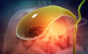 Sỏi lấp 1/4 túi mật, chưa đau dùng TPBVSK Kim Đởm Khang được không?