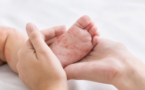 Bất dung nạp lactose hoàn toàn khác dị ứng đạm sữa bò  