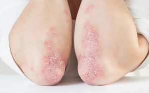 Thực phẩm siêu chế biến có thể tăng nguy cơ mắc vảy nến