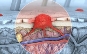 Hàng trăm triệu người trên thế giới sống chung với herpes sinh dục
