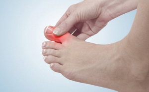 Bệnh u xương ngón chân cái và lời khuyên từ chuyên gia 