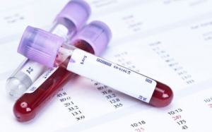 Xét nghiệm máu giúp dự đoán nguy cơ mất trí nhớ?