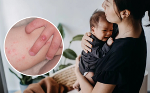 Những điều cần biết về bệnh tay chân miệng