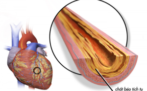 Biến chứng nguy hiểm của xơ vữa động mạch vành và cách phòng ngừa từ thảo dược 