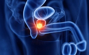 Nga đăng ký loại thuốc mới điều trị ung thư tuyến tiền liệt di căn xương