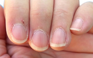 Biện pháp chăm sóc bàn tay bị xước măng rô