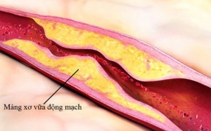 Xơ vữa động mạch gây ra biến chứng gì?