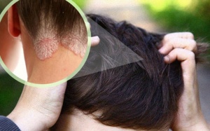 5 biện pháp tự nhiên chữa vảy nến da đầu tại nhà