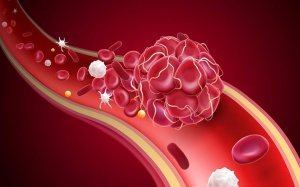 Có giải pháp nào làm tan cục máu đông?