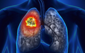 Tại sao ung thư lại thường di căn đến phổi?