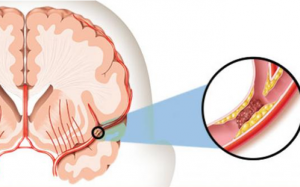 Nhận biết sớm dấu hiệu nhồi máu não