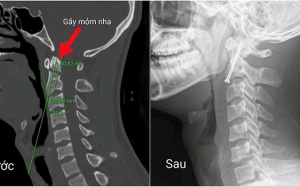 Hy vọng mới cho những người trẻ gặp chấn thương cột sống nghiêm trọng