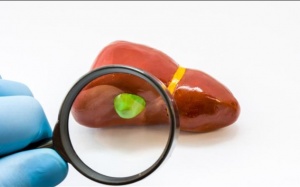 Polyp túi mật có nguy hiểm không, có nguy cơ ung thư không?