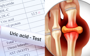 Dấu hiệu acid uric tăng cao và biện pháp kiểm soát