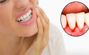 Viêm lợi có nguy hiểm không?