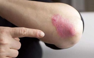 Bệnh vảy nến có trị được không? 