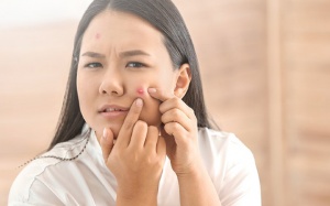 Bí quyết “đánh bay” mụn trứng cá hiệu quả nhanh