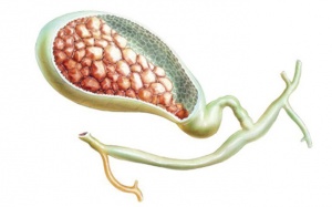 Sỏi mật 32mm có nên phẫu thuật không?