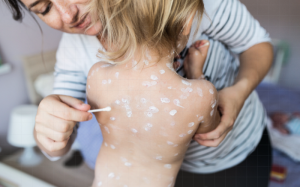 Những điều cần tránh khi bị thủy đậu