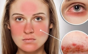 Bệnh lupus ban đỏ có chữa khỏi được không?