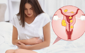 Những lầm tưởng thường gặp về nhân xơ tử cung