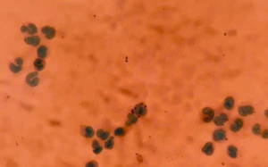 Viêm màng não mô cầu: Bệnh truyền nhiễm có thể tử vong trong 24h