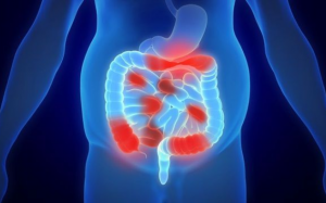 3 dấu hiệu cảnh báo sớm bệnh crohn 