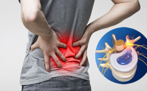 Dấu hiệu nhận biết thoát vị đĩa đệm L4-L5 