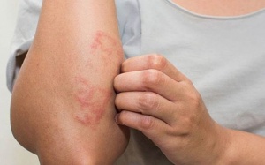 Triệu chứng viêm da cơ địa và cách kiểm soát bệnh từ thảo dược