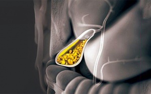 Sỏi bùn chiếm 1/3 túi mật, dùng TPBVSK Kim Đởm Khang còn tốt không?