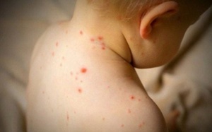 Số ca mắc sởi vẫn cao, làm sao để phòng ngừa?