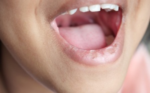 Thủy đậu mọc trong miệng có nguy hiểm không?