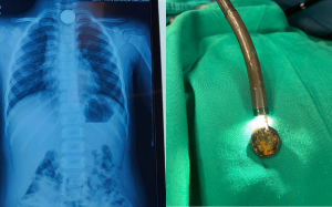 Trẻ 4 tuổi  suýt thủng thực quản do pin cúc áo 