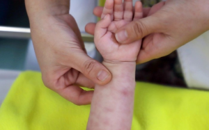 2 trẻ tử vong sau sốt phát ban ở Quảng Nam, Bộ Y tế cảnh báo dịch sởi