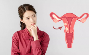 U xơ tử cung dưới 50mm có nguy hiểm không?