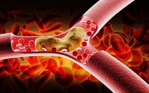 Bị mỡ máu cao nguy hiểm thế nào?