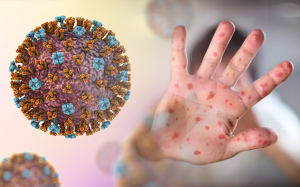 Không chủ quan với sự trở lại của bệnh sởi