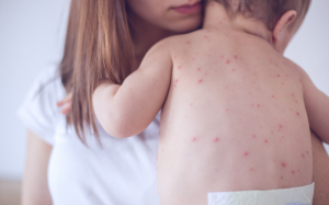 Tác hại lâu dài của bệnh sởi đối với hệ miễn dịch