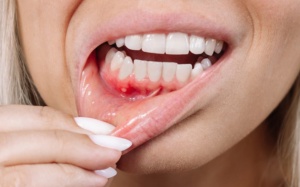 Viêm quanh răng có thể gây mất răng