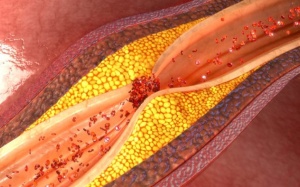 Bệnh thiếu máu cơ tim có chữa khỏi được không?