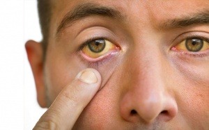 Vì sao sỏi mật gây vàng da?