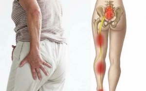 Cách phòng ngừa bệnh đau thần kinh tọa