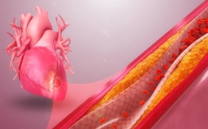 Hẹp mạch vành 70%, chưa đặt stent có nguy hiểm không?