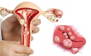 Nhân xơ tử cung loại 5 là gì?